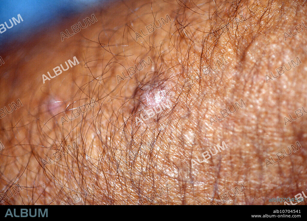 Prurigo nodularis (picker's nodule) mimicking a tumor. This skin disease is characterized by pruritic (itchy) nodules and usually appears on the arms or legs.