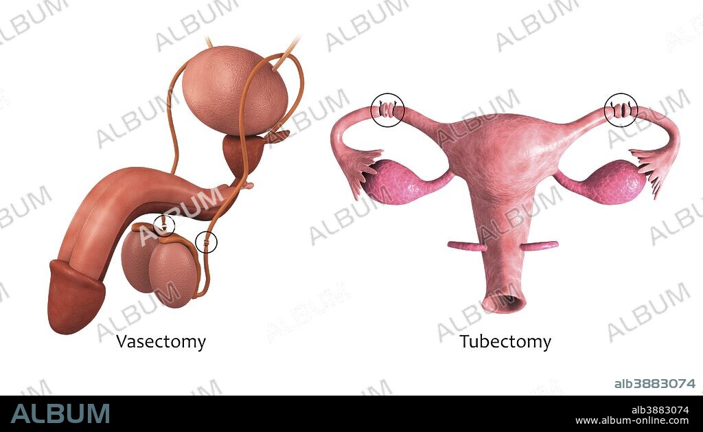 Biomedical illustration of a vasectomy in the male reproductive organs and a tubectomy in a woman's reproductive organs.