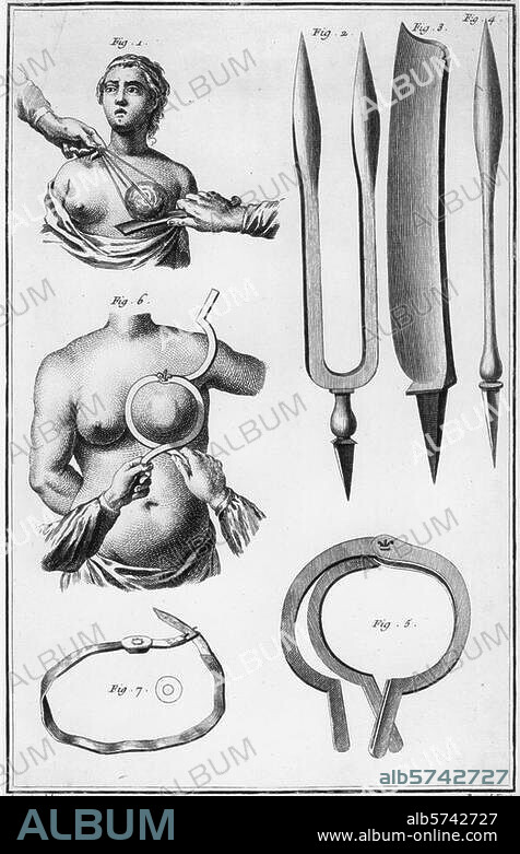 Médecine : opération. "Chirurgie". (Instruments et technique d'ablation du sein). Gravure sur cuivre de Benard d'ap. Goussier. In : D. Diderot et J. B.D'Alembert, Encylopédie des Sciences, des Arts et des Métiers, 1751-1781. Berlin, Sammlung Archiv für Kunst und Geschichte.