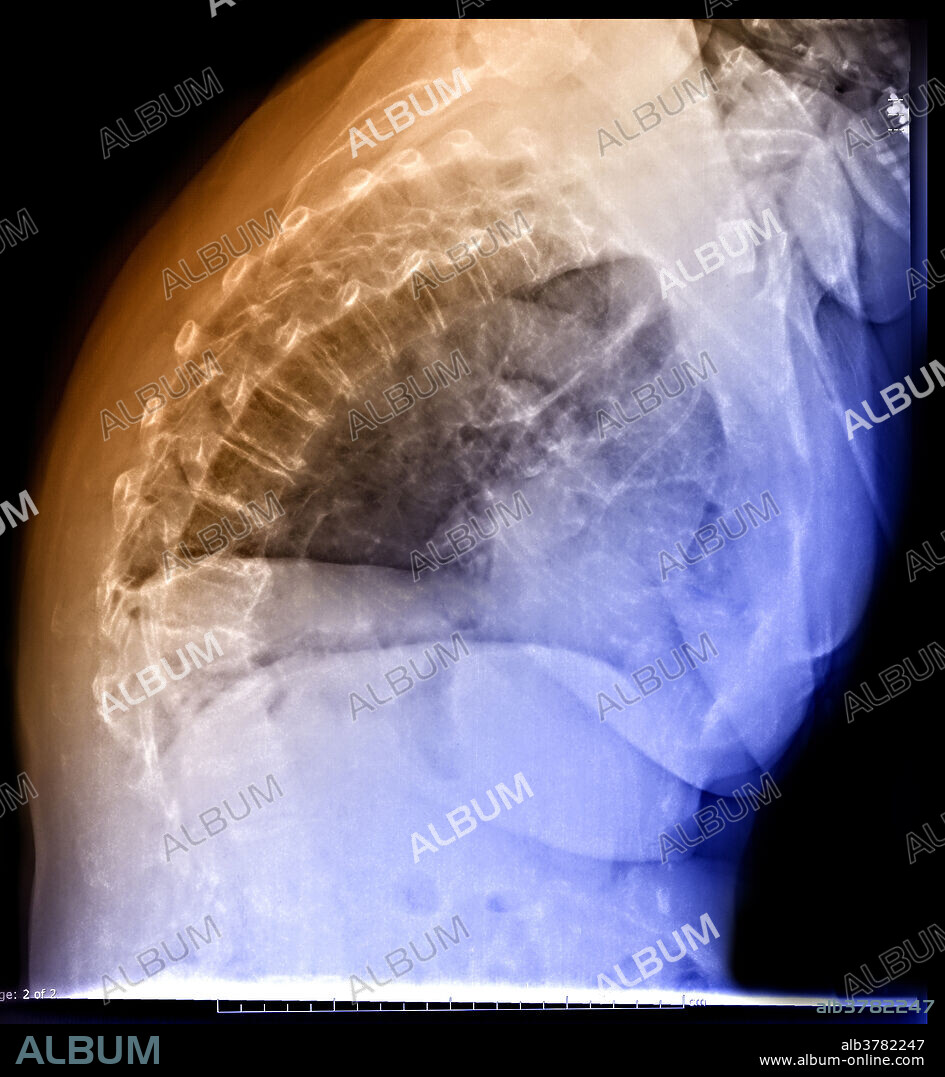 Color-enhanced x-ray of dowager's hump. This is an abnormal outward curvature of the vertebrae of the upper back. Compression of the front (anterior) portion of the involved vertebrae leads to forward bending of the spine (kyphosis) and creates a hump at the upper back. Dowager's hump is due to osteoporosis changes in the thoracic spine. It may affect men or women. Like most osteoporotic changes, it is often preventable.