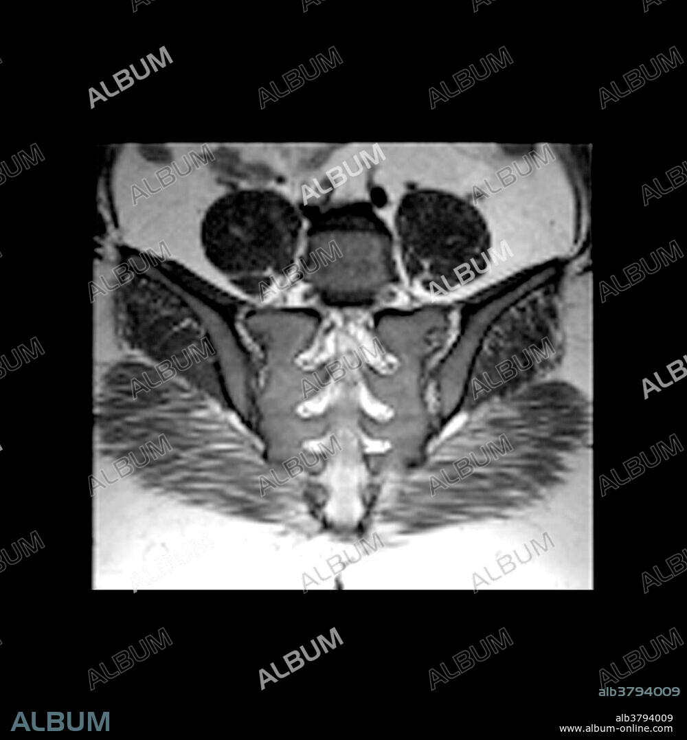 MRI of Normal Sacrum