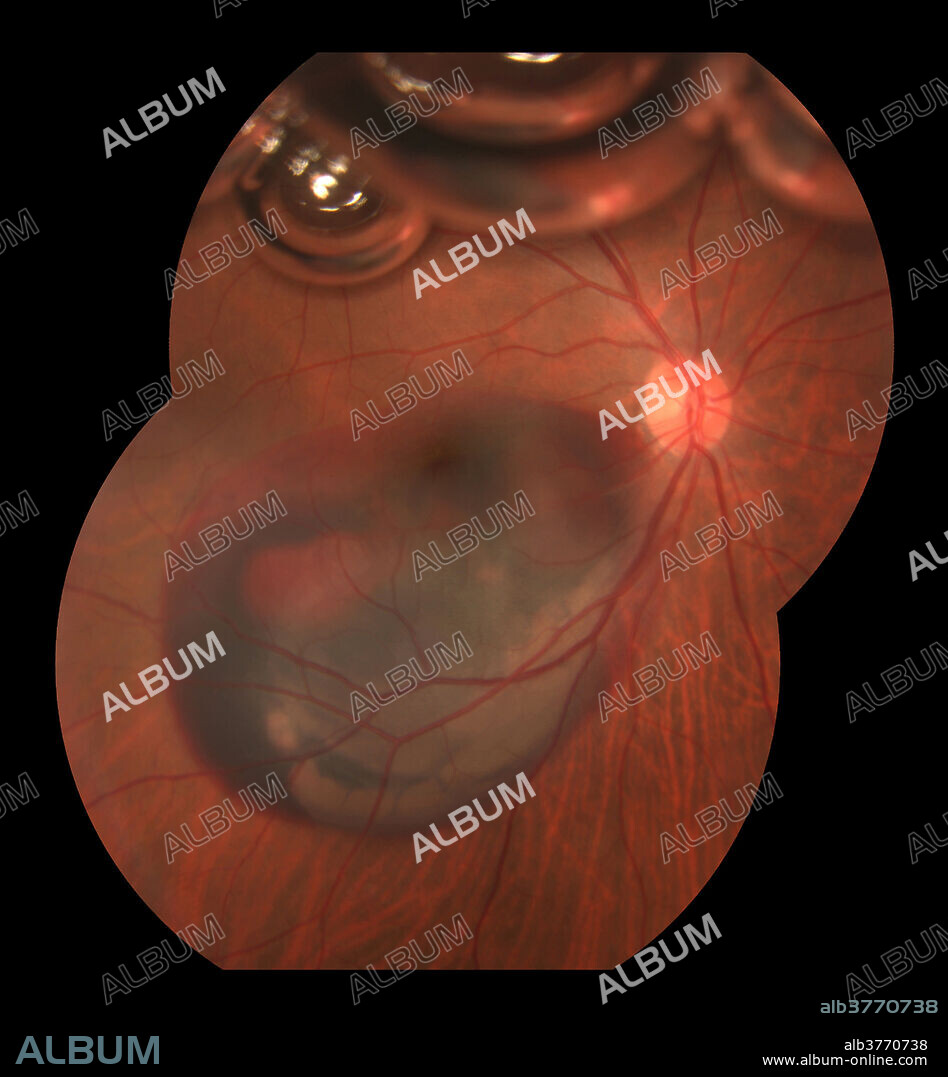 Subretinal haemorrhage with Intraocular gas bubbles that have been injected into the vitreous cavity to displace a submacular blood. The different gases that are commonly used are sulphur hexafluoride (SF6), perfluoropropane (C3F8), perfluoroethane (G2F6), and air. The gas is gradually absorbed and disappears between one and eight weeks depending on which type is used.