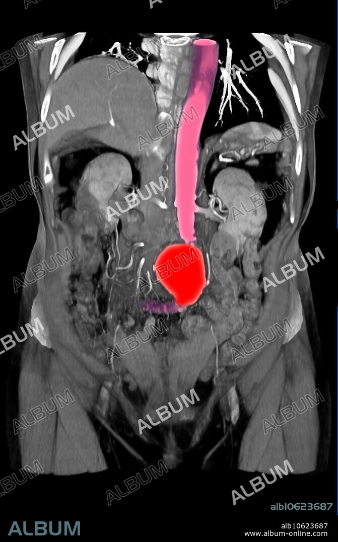 CT scan images showing an abdominal aortic aneurysm, which developed between the renal arteries and the common iliac arteries. The liver, spleen and kidneys also appear prominently in this image.