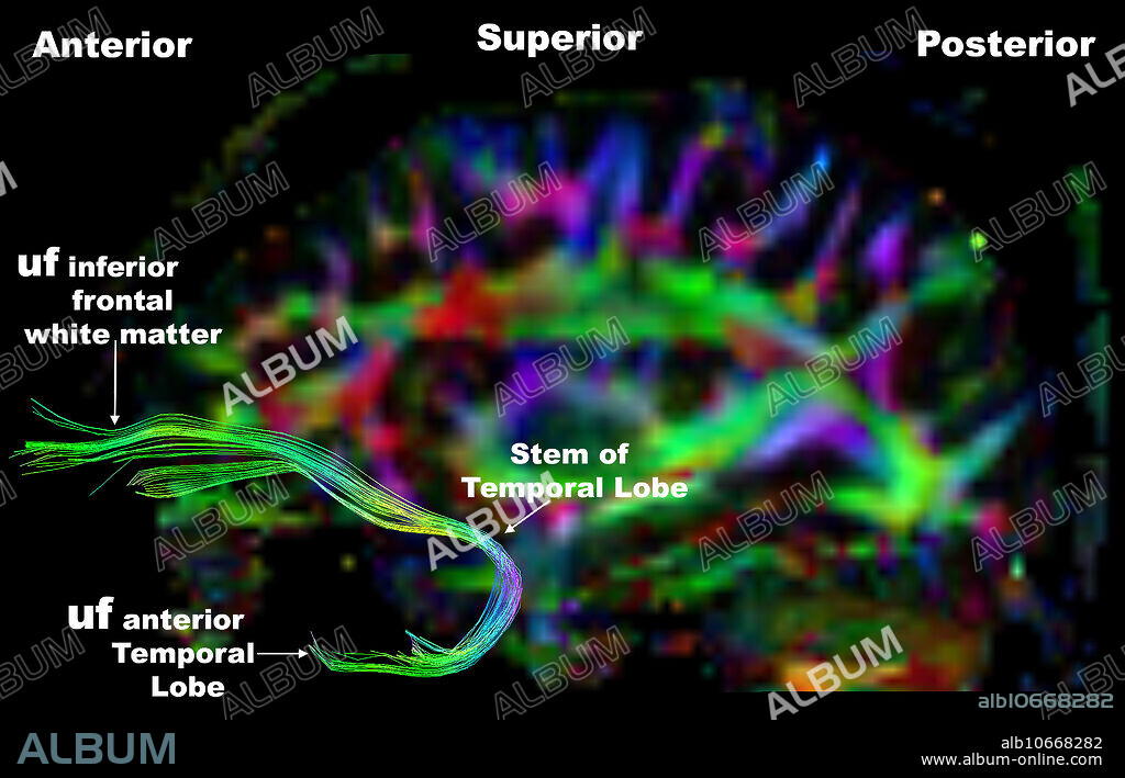 Uncinate Fasciculus tractography. Diffusion tensor imaging (DTI) with generation of colour diffusion tractography can have significant impact on how a brain tumour is resected. The information diffusion tractography provides the neurosurgeon helps plan a safer resection or partial resection. Tractography can help us determine whether a certain tract is destroyed or infiltrated with tumour or merely displaced by a mass. In the latter instance we can tell the neurosurgeon how the tract is displaced and where the tract is located relative to the mass, again providing information to the neurosurgeon, which may allow a safer resection. uf = uncinate fasciculus.