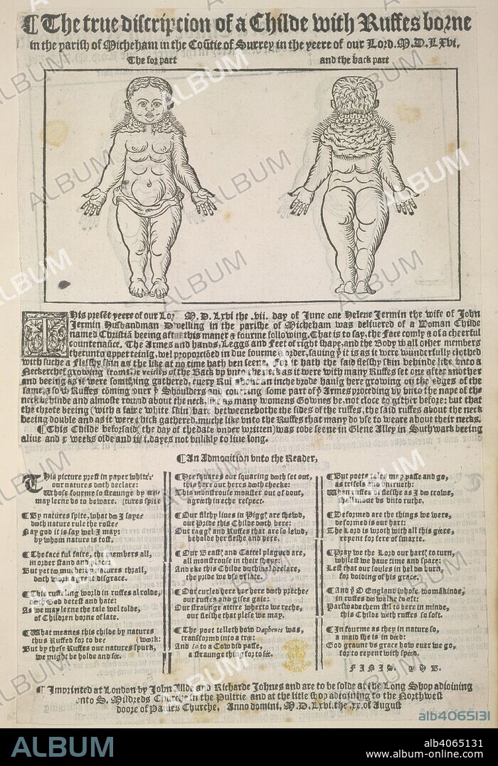Childe with Ruffes. The True Discripcion of a Childe with Ruffes borne. Iohn Allde and Richarde Iohnes: London, 1566. A description of a child born with hair around its neck, like a ruff. Image taken from The True Discripcion of a Childe with Ruffes borne in the parish of Micheham in the CouÂ¯tie of Surrey in the yeere of our Lord M.D.LXVI. [A ballad, signed: H. B. With a woodcut.]. Source: Huth.50, 34. Language: English.