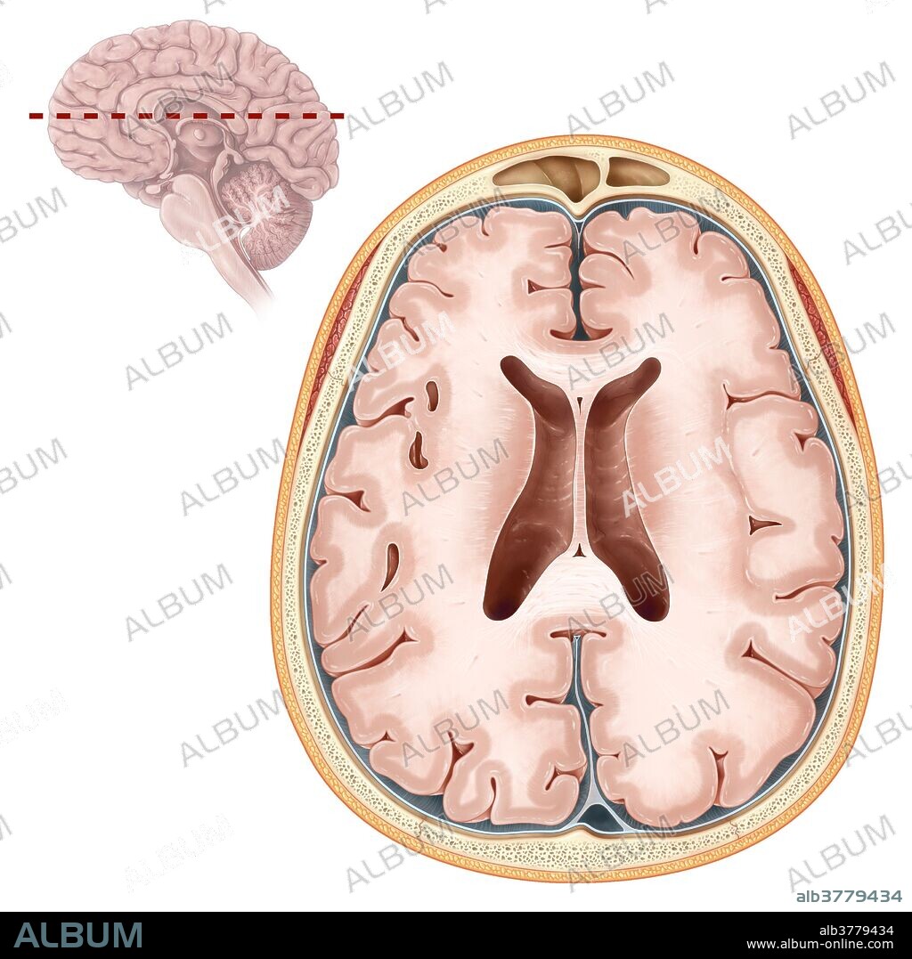 An illustrated transverse section of the brain depicting the body of the lateral ventricle, the genu and splenium of the corpus callosum, and the caudate nucleus. (The brain's the white matter is colored light beige and the grey matter of the cerebral cortex is dark beige).