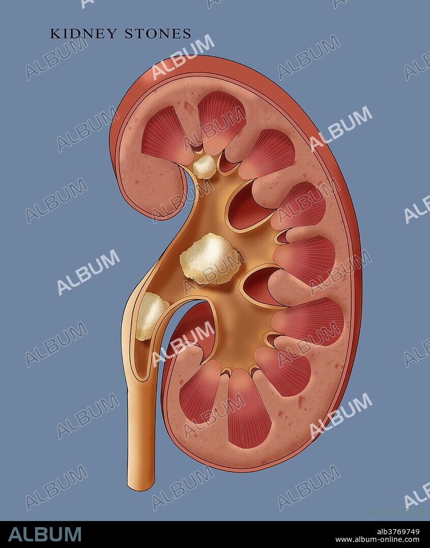 Illustration showing three types of kidney stones: Calyceal stone (top), renal pelvic stone (middle), upper ureteral stone (bottom). Kidney stones are formed when mineral salts, most often involving calcium, accumulate on the inner surfaces of the kidney. As they grow they may block the flow of urine out of the kidney, causing extreme pain.