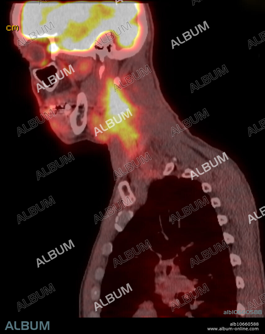 Positron emission tomography of 60 yo male with right squamous cell carcinoma of the tongue. Sagittal FDG CT PET scan reveals large conglomeration of lymph nodes within the right neck beginning at the angle of the mandible and extending to the level lower neck (level 5) and also extension into the posterior triangle. The mass is deep to the sternocleidomastoid. Mass extends posteriorly into the posterior triangle. Corresponding intense metabolic uptake with SUV of 6.0. There is focal asymmetric uptake involving the base the tongue, with SUV of 4.9.