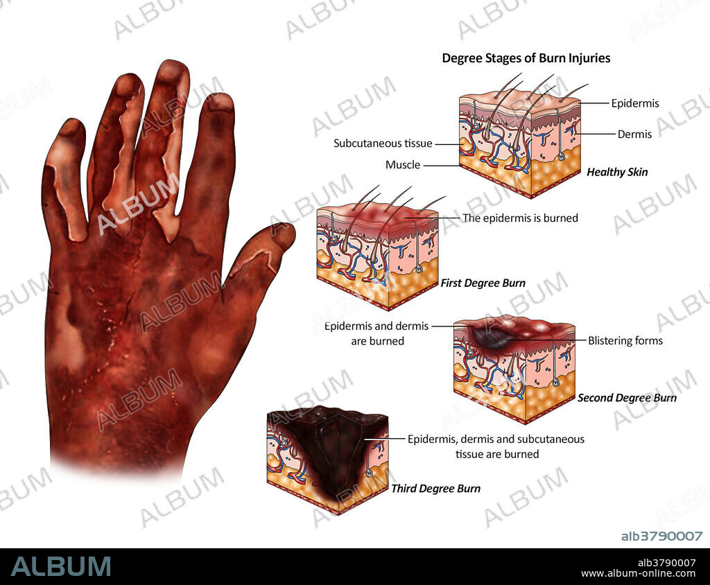 Illustration showing the stages of burns; first degree burn, second degree burn and thrid degree burn.