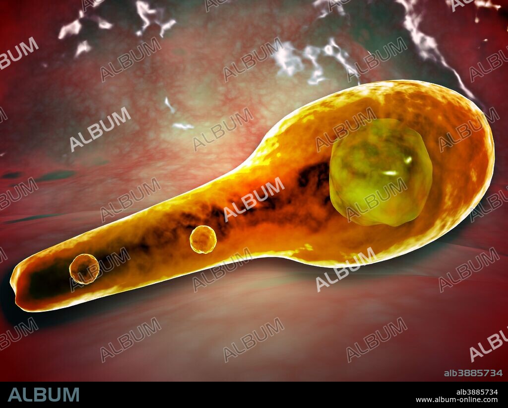 Microscopic view of Tetanus. Tetanus is caused by the tetanus bacterium, Clostridium tetani. Tetanus is often associated with rust.