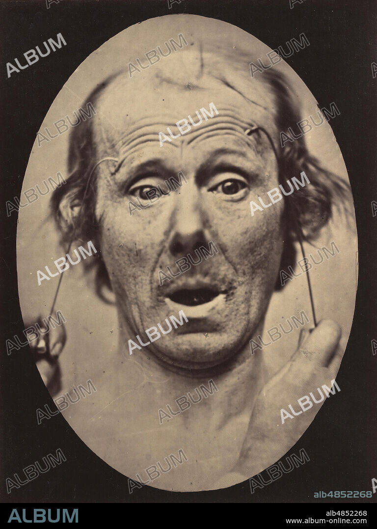 DUCHENNE DE BOULOGNE and ADRIEN ALBAN TOURNACHON. Figure 56: Surprise, 1854-56, printed 1862.