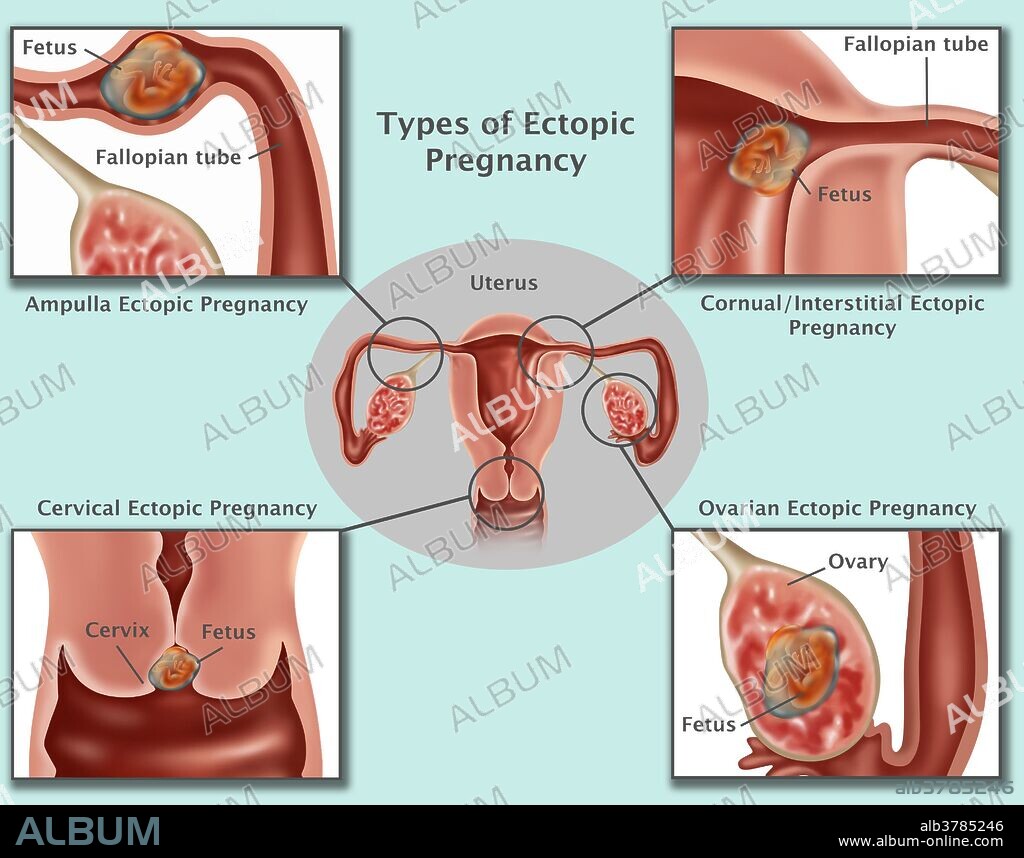 Illustration of common ectopic pregnancies. Pregnancies occurring in the Ampulla (top left), Interstitial Fallopian Tube (top right), cervix (bottom left), and the ovary (bottom right). As the ectopic pregnancy develops, the growing embryo may rupture the surrounding tissues causing serious bleeding. Surgery is usually performed to remove the embryo, and to repair or remove the area of implantation.