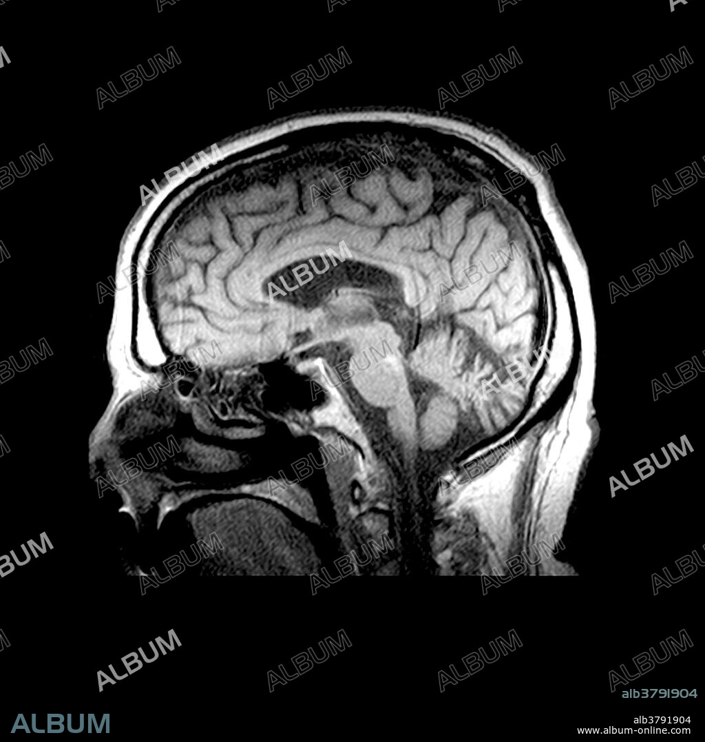This sagittal (from the side) T1 weighted MRI image of the brain shows severe preferential atrophy involving the superior vermis of the cerebellum. This person was a chronic alcoholic. One of the manifestions of chronic alcoholism in the brain is atrophy, which can selectively and more severely involve the superior aspect of the cerebellar vermis. Also note that the image is somewhat degraded by excessive patient motion. This person was sufferring from 'delirium tremens' withdrawal symptoms, making it difficult for them to hold still for the exam.