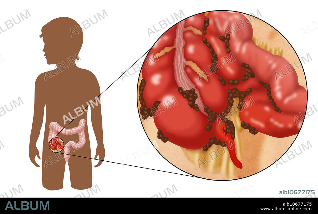 An Illustration of a ruptured appendix caused by untreated appendicitis. The brown particles on the ruptured appendix represents escaped faecal matter from the large intestine.
