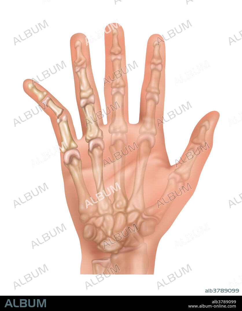 Illustration showing a dislocated little (or 5th) finger.