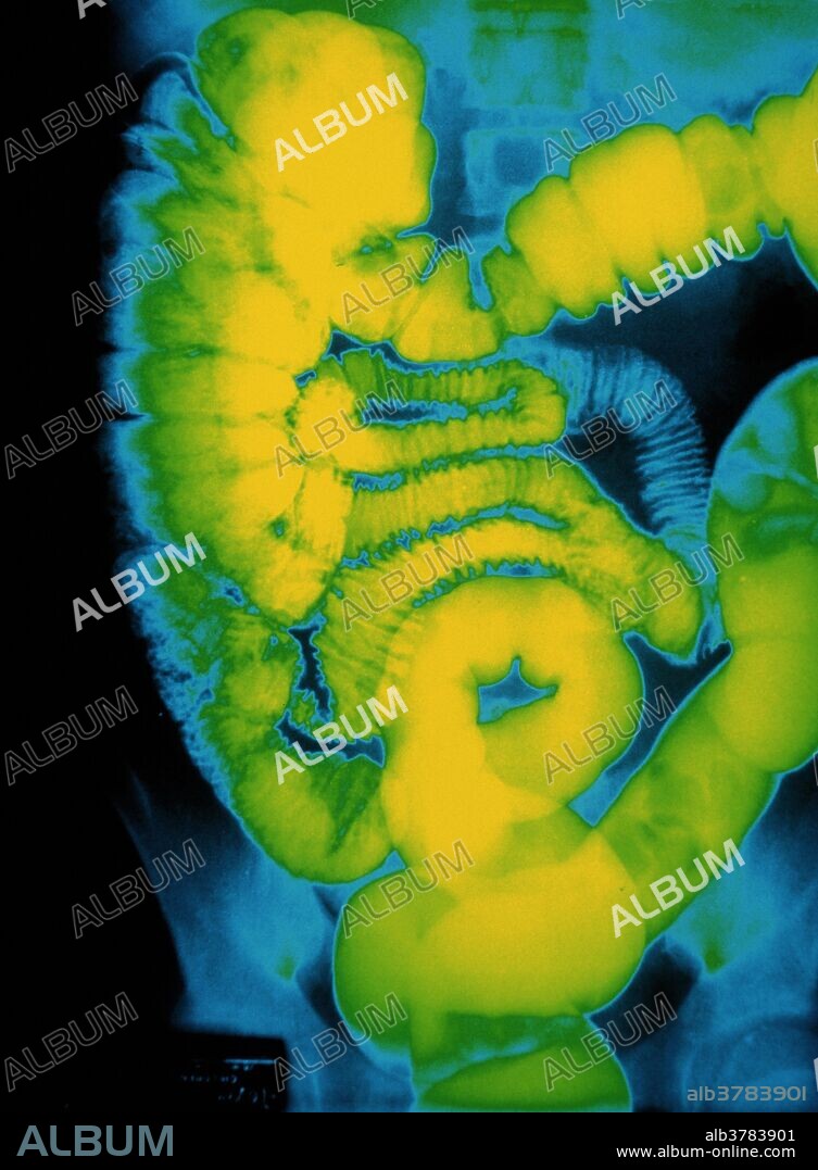 Large intestine. Colored X-ray image of the human abdomen showing the large intestine (colon), after a barium enema. At center are loops of the small intestine. These lead into the dilated colon, of which there are three regions. At left is the ascending region of the colon; at top, the transverse colon runs horizontally, leading to the descending colon (at right). At bottom center is the rectum. The colon absorbs water and electrolytes from digested food; periodic muscular contractions move the dehydrated contents (feces) towards the rectum. A barium enema is a suspension of barium sulphate (which is opaque to X-rays) that is infused into the rectum.