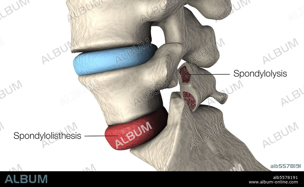 Medical illustration highlighting spondylolisthesis and spondylolysis in the human vertebra.