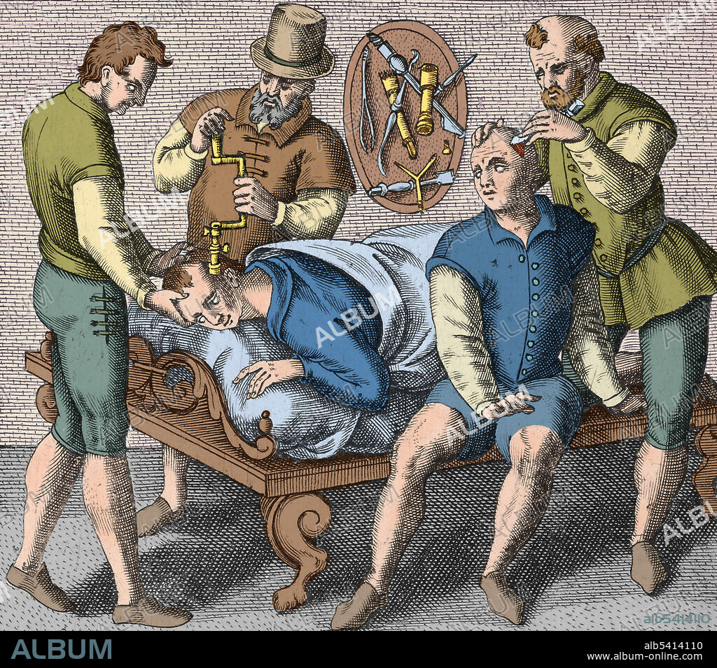 Trepanning being performed on the skull, 1594. Trepanning is a surgical intervention in which a hole is drilled or scraped into the human skull, exposing the dura mater to treat health problems related to intracranial diseases. Cave paintings indicate that people believed the practice would cure epileptic seizures, migraines, mental disorders and the bone that was trepanned was kept as a charm to keep evil spirits away. Trepanation was also practiced in the classical and Renaissance periods.