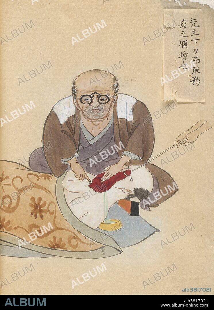 Painting of Hanaoka Seishu removing a tumor from the chest of a fully anesthetized male patient. An assistant applies traction to the tumor which is draining into a bowl beside the patient, while Hanaoka applies counter tension with his left hand. He uses his right hand to direct the blade of the scalpel to excise and extract the tumor. This picture seems designed to portray both the comfort of the patient under anesthesia and the supreme confidence of the surgeon. "A Surgical Casebook" is a manuscript of hand-painted pictures commissioned by Hanaoka Seishu. The colorful, often charming, pictures in this casebook capture the likenesses of the men and women who came to Hanaoka for treatment, and they depict graphically the medical and surgical problem to be treated. Hanaoka Seishu (October 23, 1760 - November 21, 1835) was a Japanese surgeon with a knowledge of Chinese herbal medicine, as well as Western surgical techniques. He was the first surgeon in the world who used the general anesthesia in surgery and who dared to operate on cancers of the breast and oropharynx, to remove necrotic bone, and to perform amputations of the extremities in Japan. He died in 1835 at the age of 75.