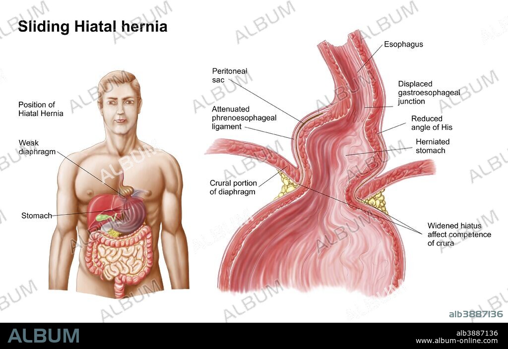 Medical ilustration of a hiatal hernia in the upper part of the stomach into the thorax.