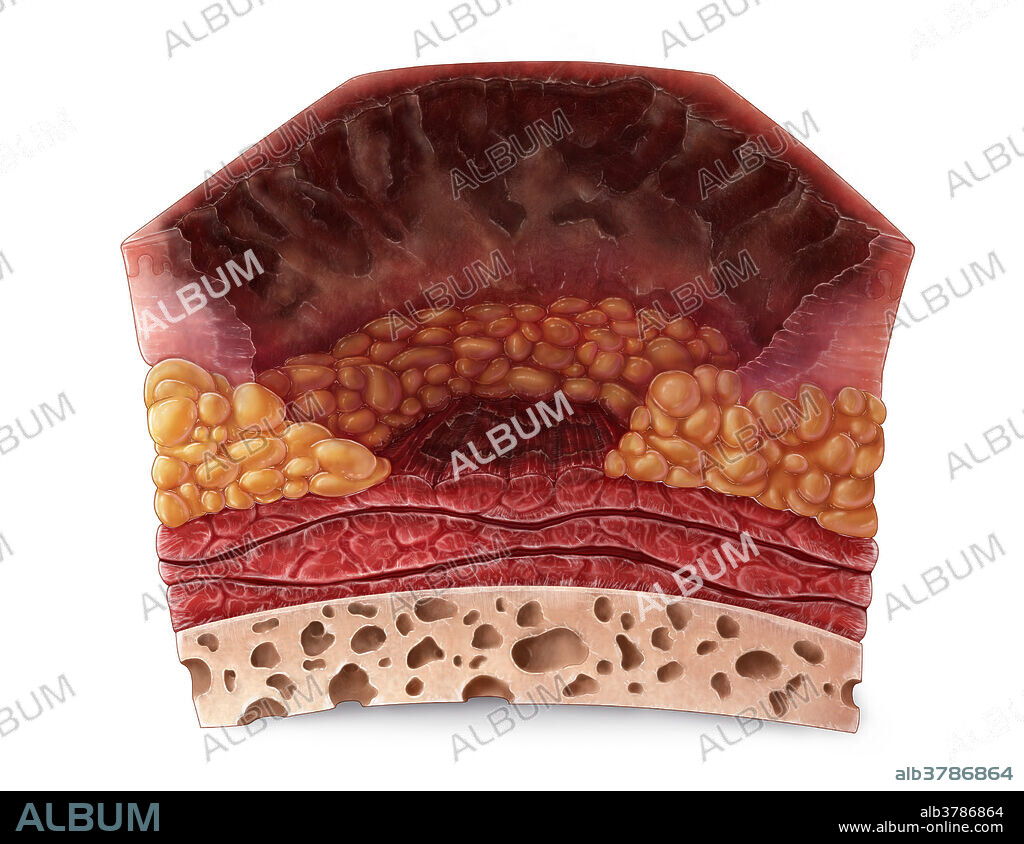 An illustration of a section of skin with a fourth degree burn. Fourth degree burns extend through the entire skin and into the underlying layers of fat, muscle, and even bone. These burns take on a blackened or charred appearance that requires excision or amputation of dead tissue.