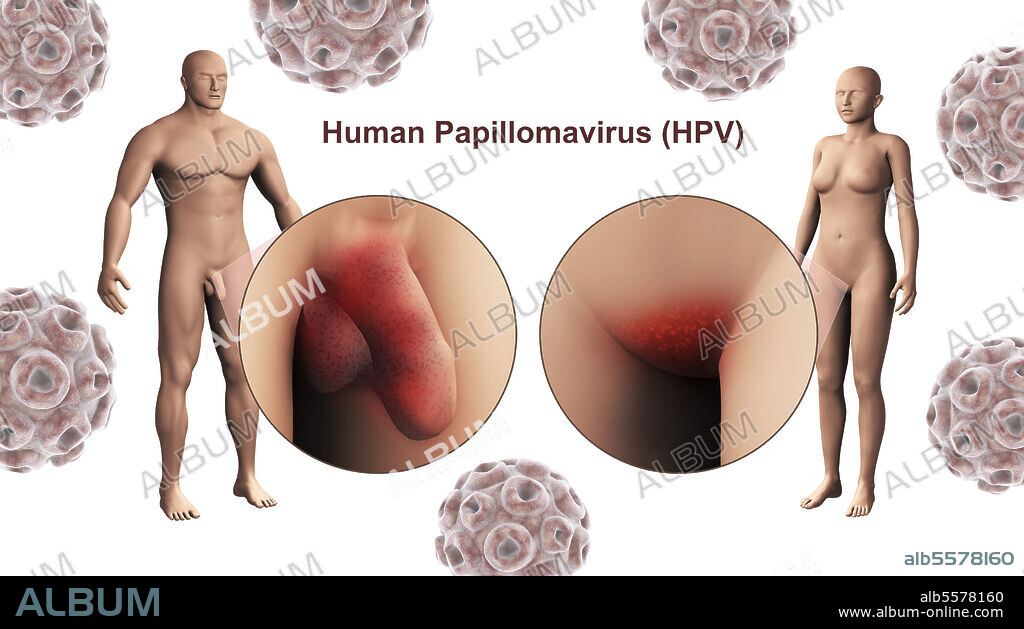 Medical illustration of the human papillomavirus infection (HPV infection) in the male and female genitals.