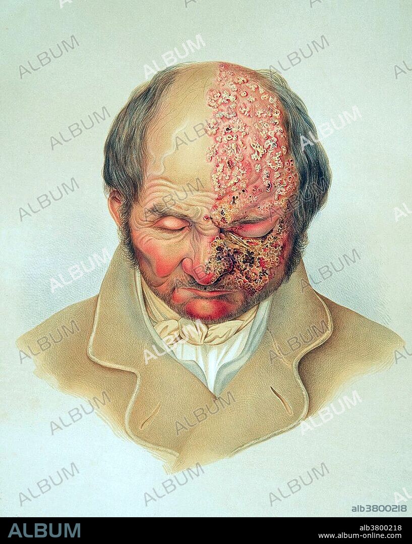 Lithograph from Ferdinand Ritter von Hebra's Atlas, part 6, plate 7, showing a bald man, his head slightly bent down, with herpes zoster (shingles) on face and pate. Herpes zoster (or simply zoster), commonly known as shingles and also known as zona, is a viral disease characterized by a painful skin rash with blisters in a limited area on one side of the body, often in a stripe. The initial infection with varicella zoster virus (VZV) causes the acute (short-lived) illness chickenpox which generally occurs in children and young people. Once an episode of chickenpox has resolved, the virus is not eliminated from the body but can go on to cause shingles, an illness with very different symptoms, often many years after the initial infection. Herpes zoster is not the same disease as herpes simplex despite the name similarity (both the varicella zoster virus and herpes simplex virus belong to the same viral subfamily Alphaherpesvirinae).