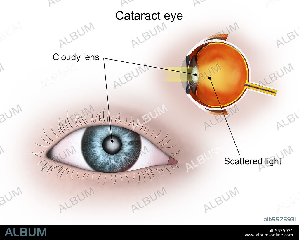 Medical illustration of a cataract in the human eye.