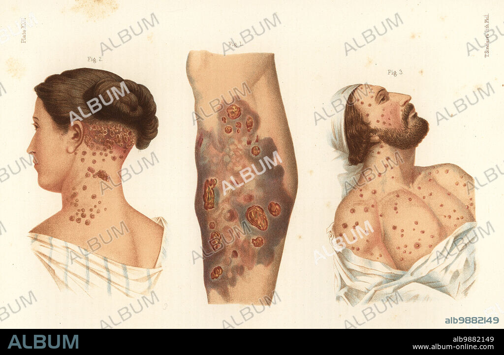Pustular syphilide with ecthyma of the leg 1, pustular syphilide or impetigo of the neck 2, and vesicular syphilide on the face and neck 3. Chromolithograph by T. Sinclaire from Freeman J. Bumsteads Atlas of Venereal Diseases, Henry C. Lea, Philadelphia, 1868. First American edition of Auguste Culleriers Precis iconographique des maladies veneriennes.