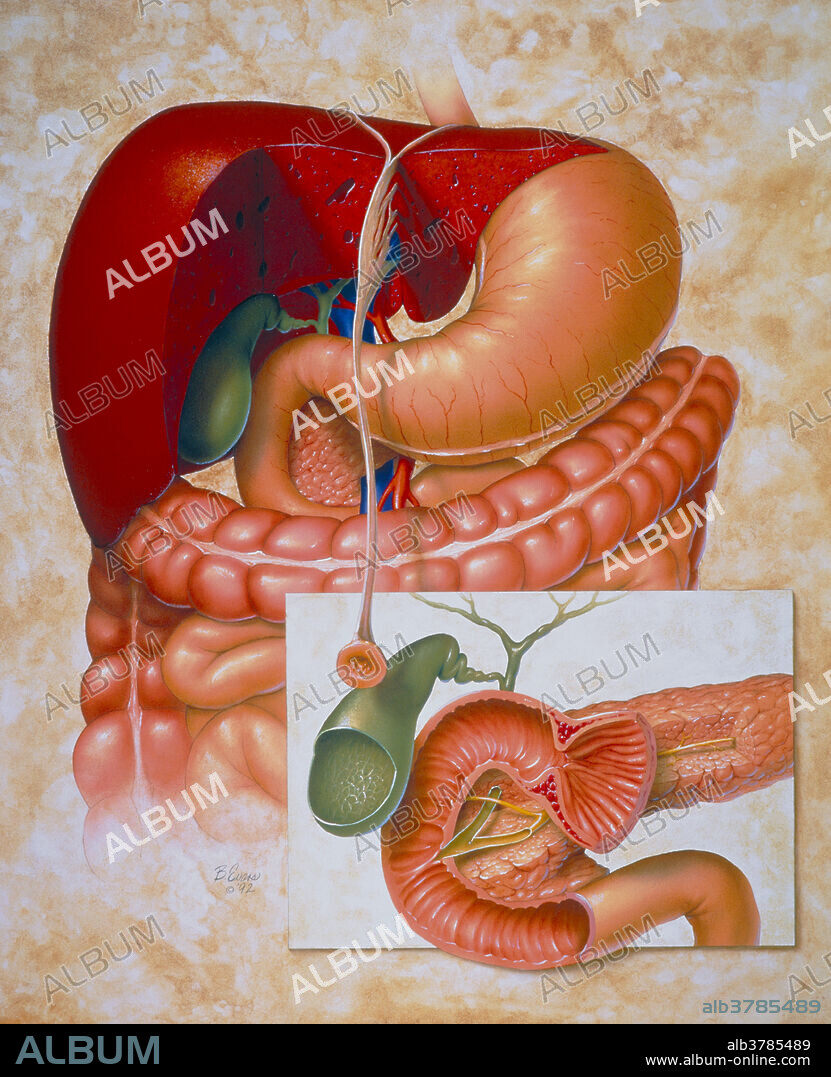 Digestive system. Artwork showing a healthy human digestive system. Food enters the stomach (pink, upper right) where it is stored and churned up ready for digestion in the small intestine (attached tube below). As food passes into the small intestine, bile from the liver (red, upper left), which is stored and concentrated in the gall bladder (green), is released to aid the breakdown of fats. The pancreas, in the U-shaped section of the small intestine, releases digestive enzymes. Food residue then passes into the large intestine or colon (darker pink), a muscular tract in which excess water is absorbed. Some of these structures are seen in section at lower right.