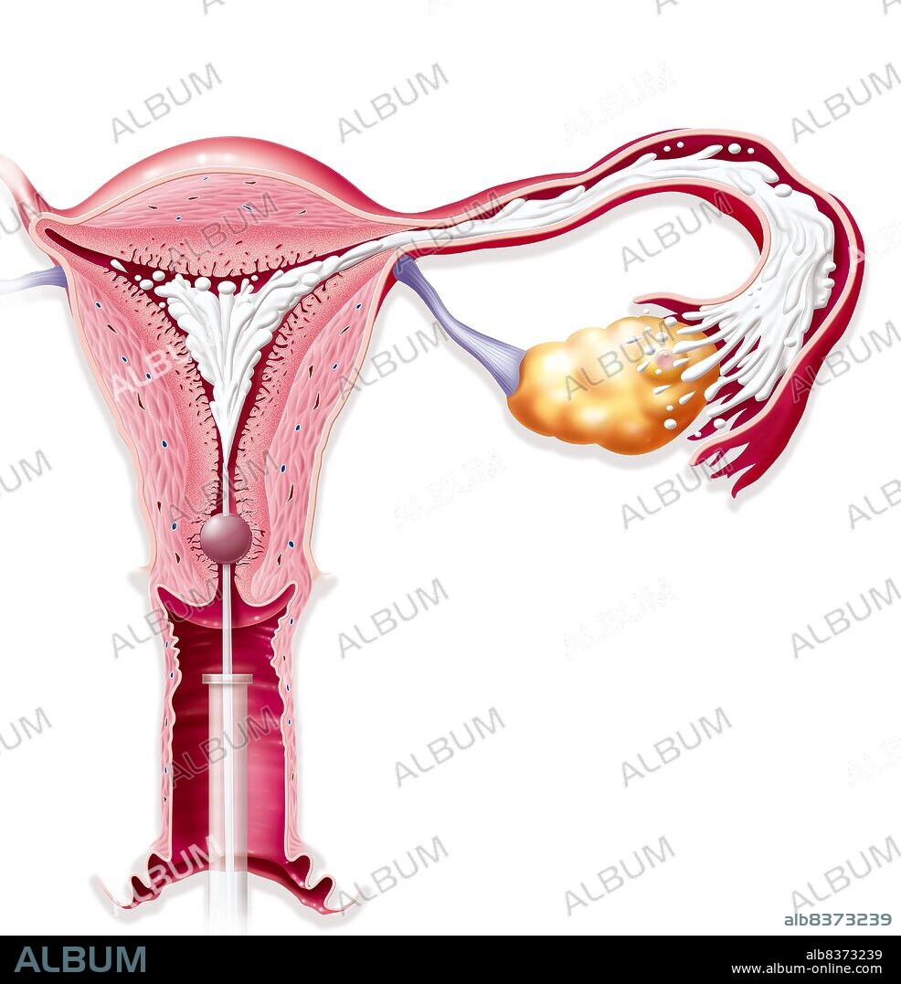 Illustration of hysterosalpingography: a radiologic procedure of the uterine cavity and fallopian tubes which enables malformations and tumours in the reproductive system to be detected. The procedure consists of injecting a radiographic contrast medium into the uterus then carrying out the x-rays.