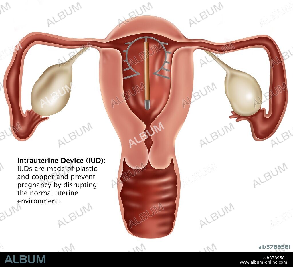 Intrauterine Device