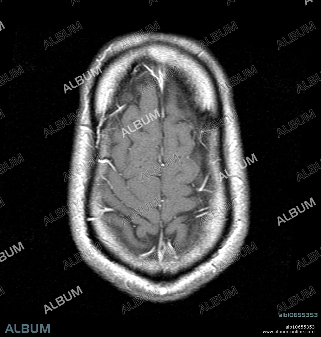 This axial (cross sectional) T1 weighted MRI demonstrates a congenital skull deformity called dolichocephaly or scaphocephaly. This is a long, narrow head and is due to premature closure of the sagittal suture.