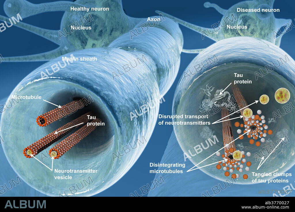 Normal microtubules are shown on the left and disintegrating microtubules on the right. The tau proteins binding the microtubules break down and form tangled masses which are thought to contribute to Alzheimer's disease and possibly chronic traumatic encephalopathy (CTE) in football players and war veterans. additionally, the flow of neurotransmitters to the synaptic membrane is disrupted. Labelled.