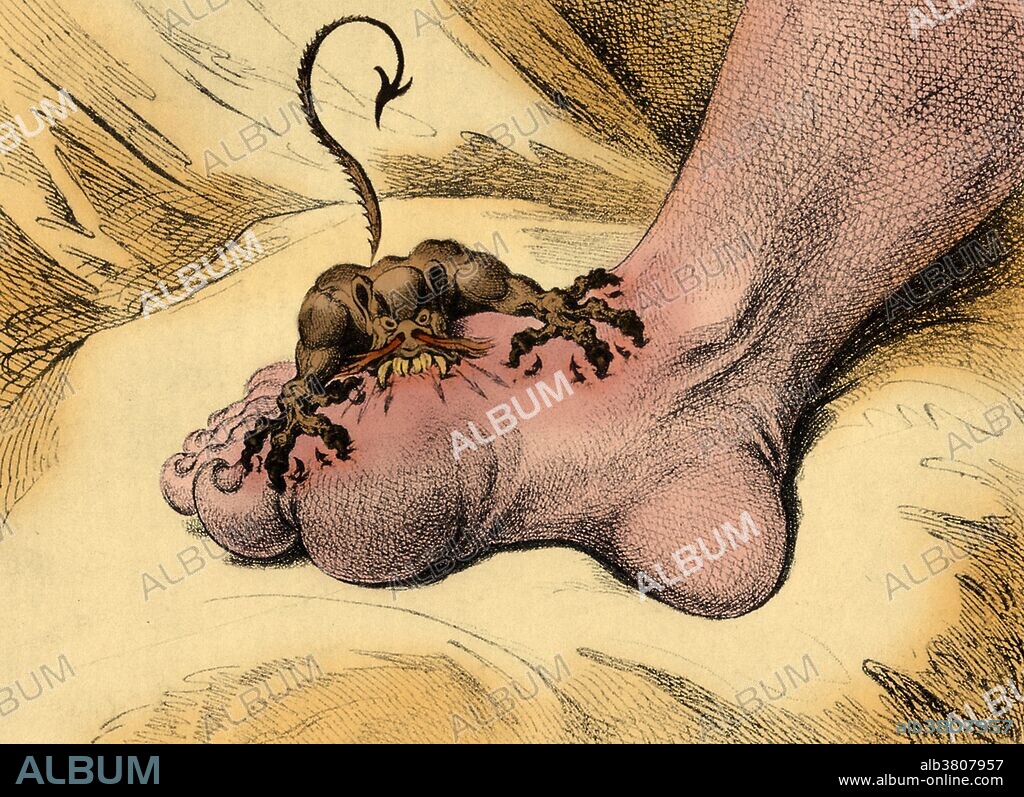 Illustration representing the pain associated with the Gout. Etching by James Gillray, 1799.