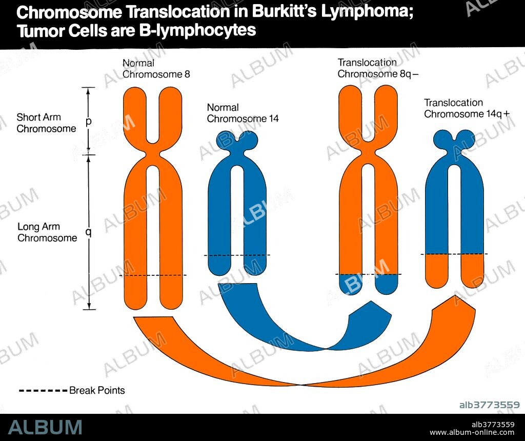 Schematic diagram of chromosomes 8, 2, 14, and 22 which are involved in the translocations (usually 8;14, less frequently 8;22 or 2;8) which occur in Burkitt's Lymphoma. The break points for these translocations are identified by the banding regions (q24, p13, q32 and q11). These break points on chromosomes 2, 14, and 22 correspond to chromosomal regions to which have been mapped the kappa, heavy chain and lambda constant region genes respectively. Burkitt lymphoma is a cancer of the lymphatic system, particularly B lymphocytes found in the germinal center.