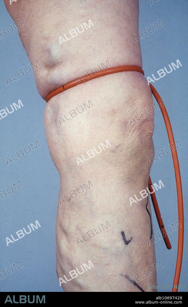The Trendelenburg test is used to determine the competency of the valves in the superficial and deep veins in the leg.
