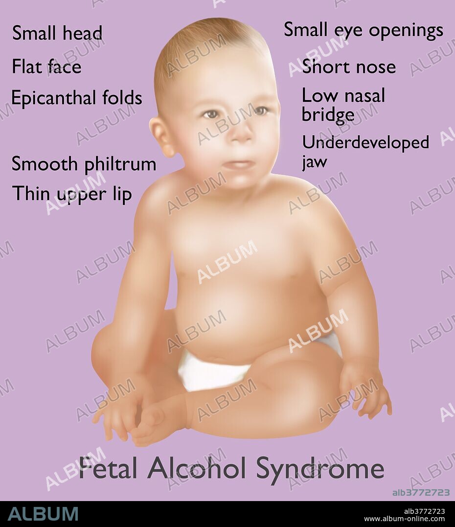 Illustration of baby with Fetal Alcohol Syndrome. Fetal Alcohol Syndrome or (FAS) is a condition in infants that is caused by alcohol consumption by the mother during time of pregnancy. Mental and physical defects such as a small head, flat face, epicanthal folds, smooth philtrum, thin upper lip, small eye openings, short nose, low nasal bridge, and underdeveloped jaw, are common symptoms of fetal exposure to alcohol.