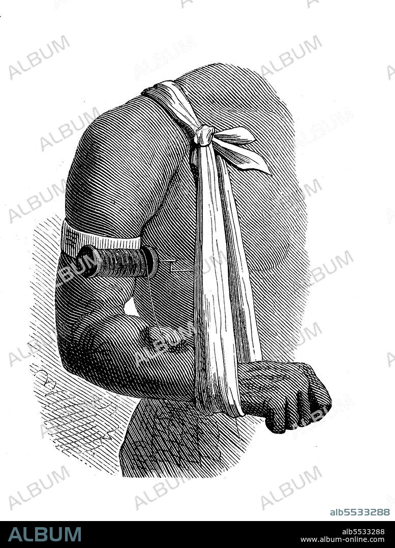 Winnowing out, removal of guinea worm, a parasitic nematode and the causative agent of dracontiasis, from a native in Dahomey, illustration from 1890.