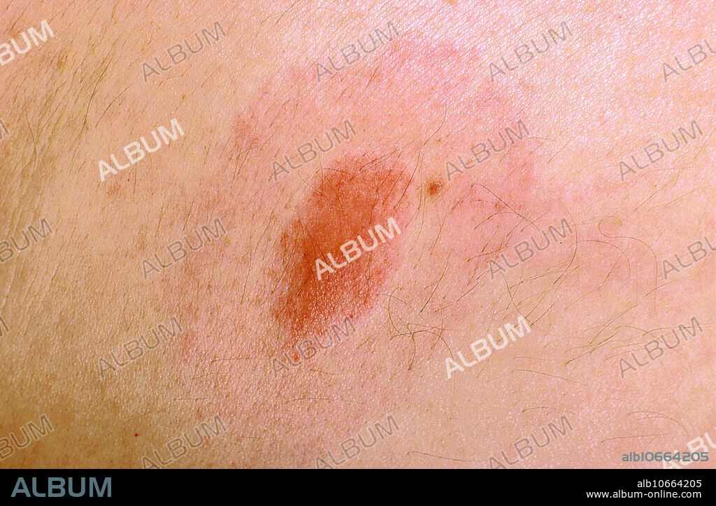 Classic 'bullseye rash' around a tick bite, indicative of Lyme disease infection.