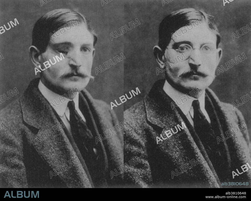 After the First World War, American sculptor Anna Coleman Ladd (1878-1939) ran the Studio for Portrait Masks in Paris, administered by the American Red Cross. With her four assistants, she made lifelike masks for disfigured French soldiers. Her workroom photographs document the "before and after" faces of each disfigured (left) and masked (right) soldier. After the patient's injury and/or restorative surgeries had healed, Ladd would take a plaster cast of his face. A mask was then crafted out of paper-thin galvanized copper and carefully painted to match skin color. Some even had real-hair mustaches. Every mask took at least a month to make. Neither function nor mobile expression could be restored, of course, but after their "plastic surgery," the grateful soldiers were able to return to their families and rejoin society without being shunned. In 1932, Ladd was made a Chevalier of the French Legion of Honor.