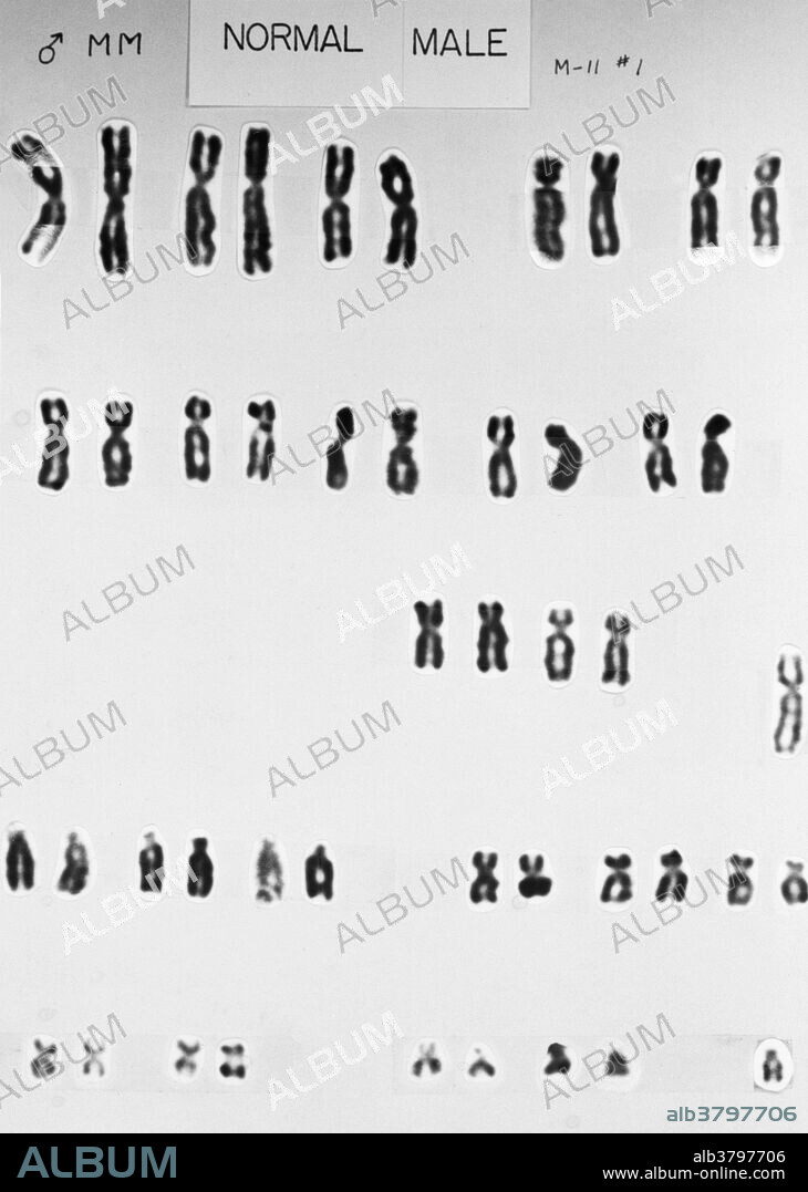 Normal, human male chromosomes. This karyotype shows the 46 chromosomes found in most cell nuclei in a man's body. There are 22 pairs of chromosomes and also the gender determining pair. In men, this comprises one X and one Y chromosome. In women, it is made up of two X chromosomes. The Y chromosome carries genetic information responsible for the development of male characteristics. Chromosomes carry genetic information in the form of genes, lengths of DNA that act as recipes for proteins. Karyotypes are an arrangement of chromosomes based on their appearance under a light microscope.