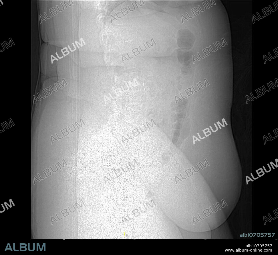 This lateral (from the side) X-ray of a person with morbid obesity shows the extensive redundancy of skin folds and fat deposition. The difficulty in seeing the underlying bones is related to the attenuation of the X-ray beam from the excess soft tissue.