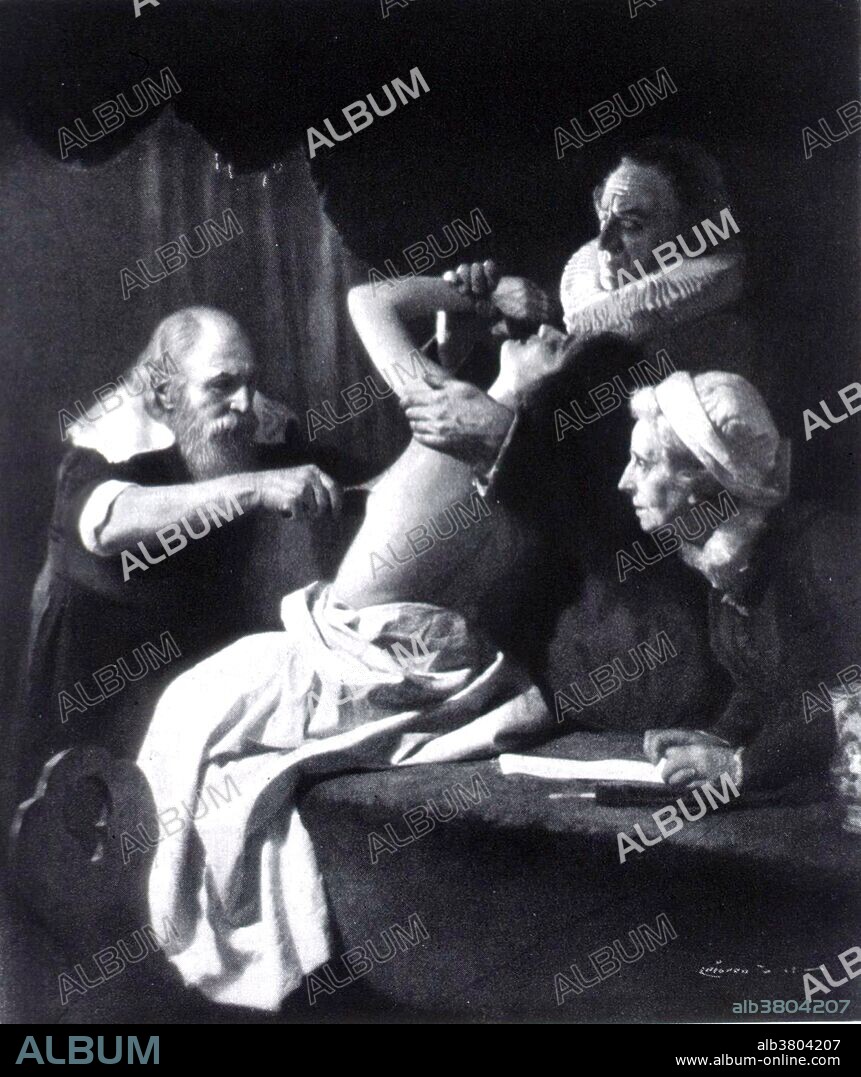 Wilhelm Fabry (1560-1634 in Bern), often called the "Father of German surgery", was the first educated and scientific German surgeon. He is one of the most prominent scholars in the iatromechanics (the medical application of physics) school and author of 20 medical books. His Observationum et Curationum Chirurgicarum Centuriae, published posthumously in 1641, is the best collection of case records of the century and gives clear insight into the variety and methods of his surgical practice.