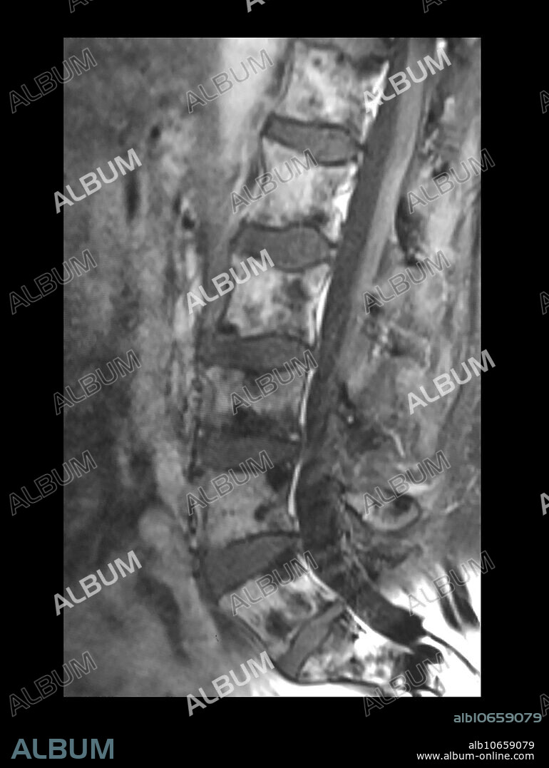 This sagittal T1 weighted MR image of the lumbar spine shows multiple sclerotic/blastic metastatic lesions to the spine which are the multiple areas of dark signal. This represents metastatic disease from prostate cancer.