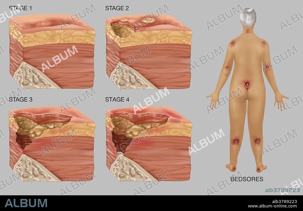 Bedsores, Illustration