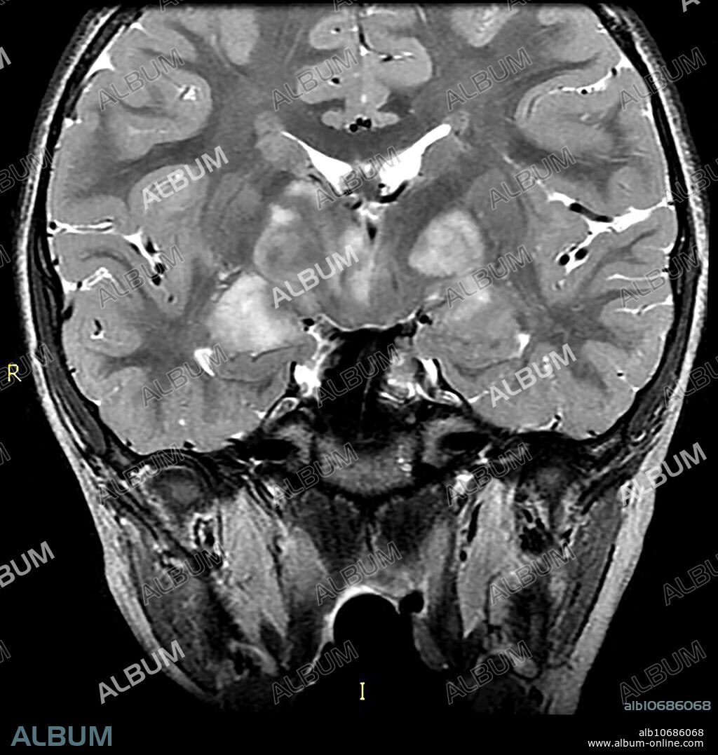 This coronal (from the front) T2 weighted MRI of a 15 year old with known NF1 demonstrates the typical appearance of foci of abnormal increased T2 signal within the basal ganglia, internal capsule and thalamus commonly seen in NF1. These foci usually wax and wane and disappear as the subject approaches the age of 20.