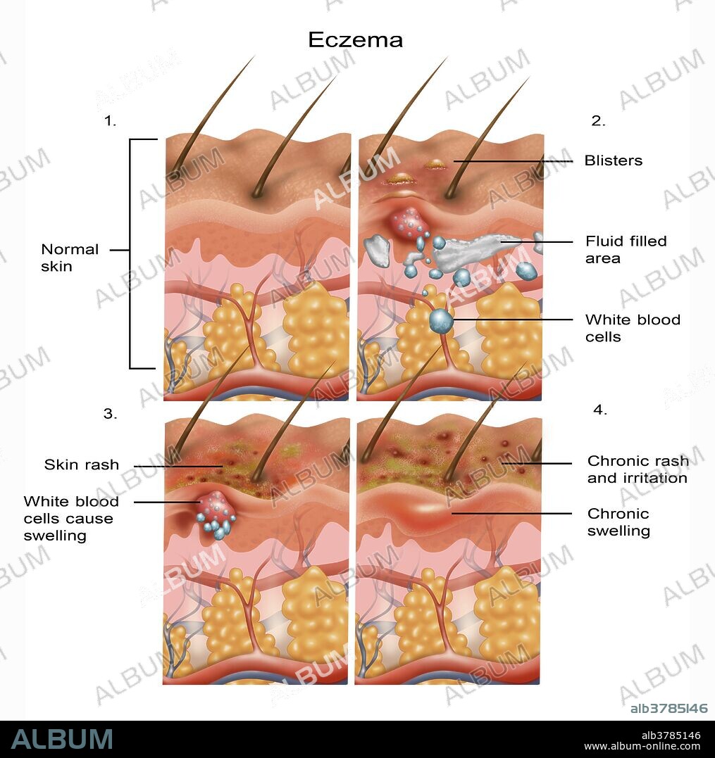 Cross-section illustration of the formation of eczema on the skin in four parts. From top left to bottom right: normal skin, blisters and skin becomes itchy, the rash transitions from acute to chronic becoming flakey, and finally the rash becomes chronic and itchy. Topical steroids and ointments are used to ease the discomfort of the eczema rash.