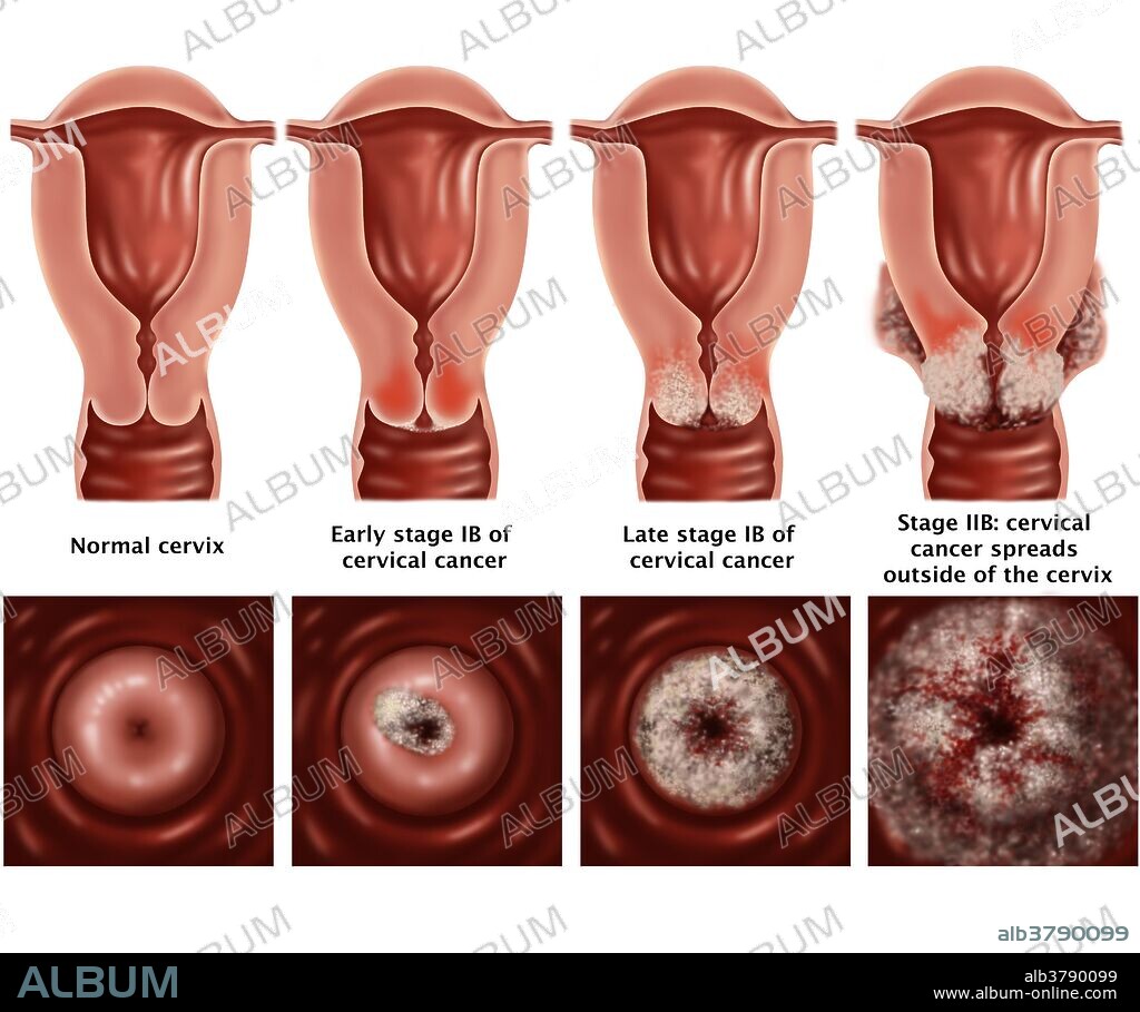 Illustration showing the progression of cervical cancer. Symptoms of cervical cancer include bleeding between periods, pain after sexual intercourse and heavier periods. Cancer of the cervix is rare and if detected early is almost always cured.