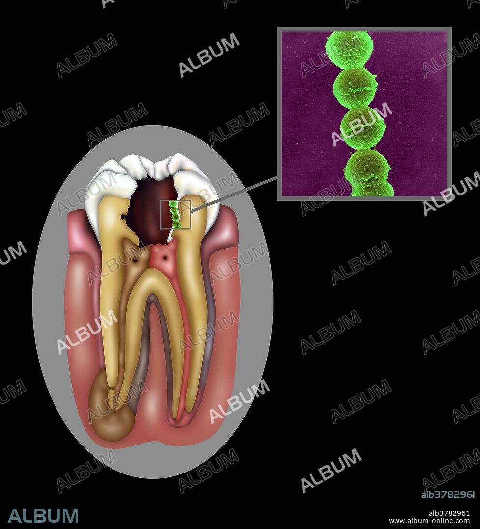Oral Infection of Streptococcus Oralis